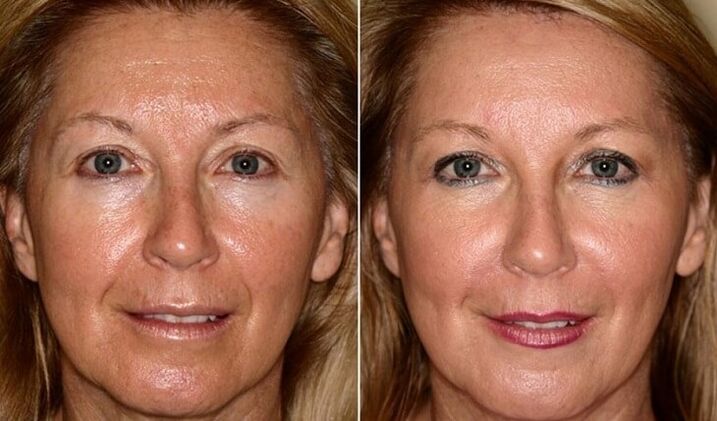 pred in po pomlajevanju kože obraza doma