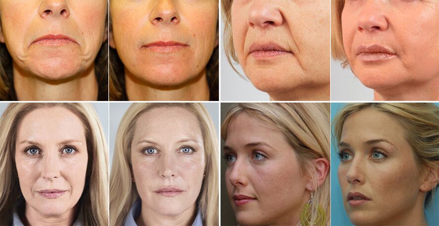 fotografije žensk pred in po pomlajevanju kože obraza