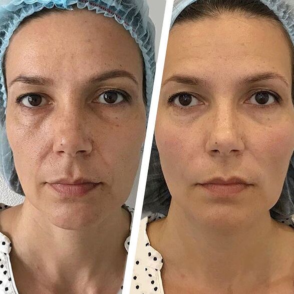 fotografija obraza pred in po laserskem pomlajevanju